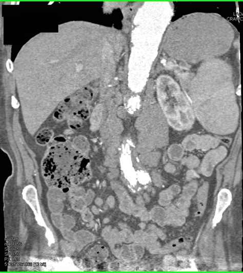 Aortic Valve Calcification And Endovascular Stents In Abdominal Aorta