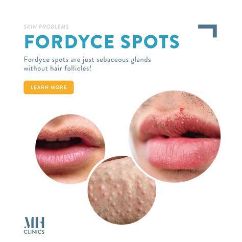 What Are Fordyce Spots Symptoms Causes Treatment