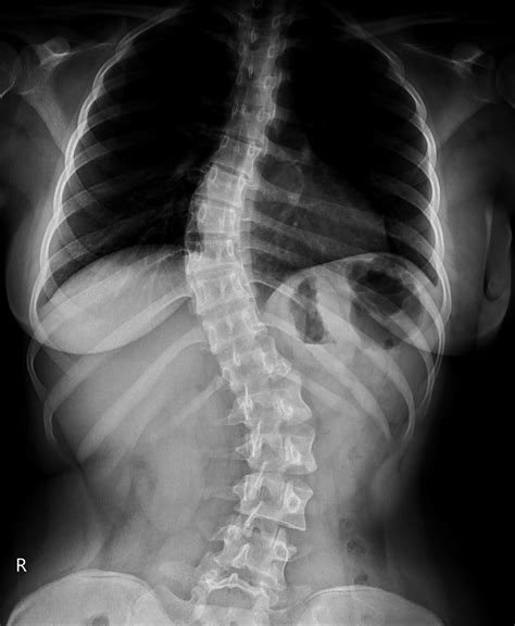 Lista 95 Foto Rx De Columna Cervical Ap Y Lateral Alta Definición