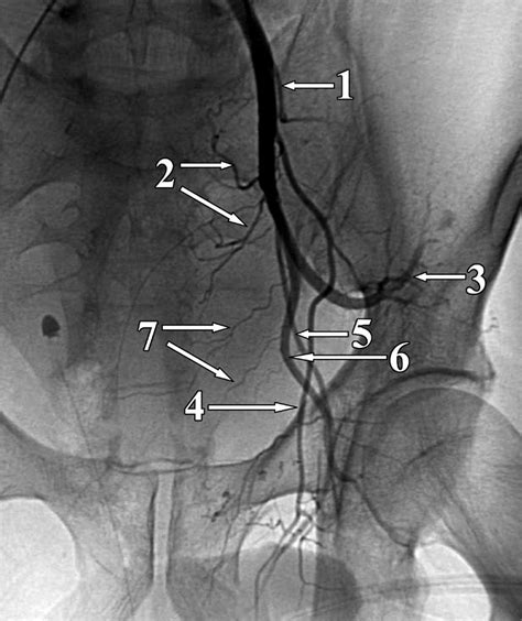 Supply pelvic wall and pelvic organs. Angiogram shows the internal iliac artery and its branches ...