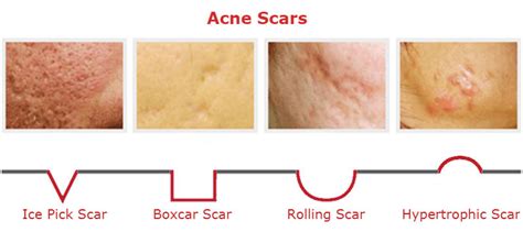 Acne Scar Treatment In Bradford Acne Scar Removal Myskyn Clinic