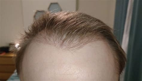 Fue Post Op Pictures Months Hair Transplant Story