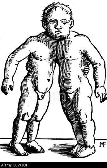 Medicine Anomalies Siamese Twins Woodcut Circa Middle Ages