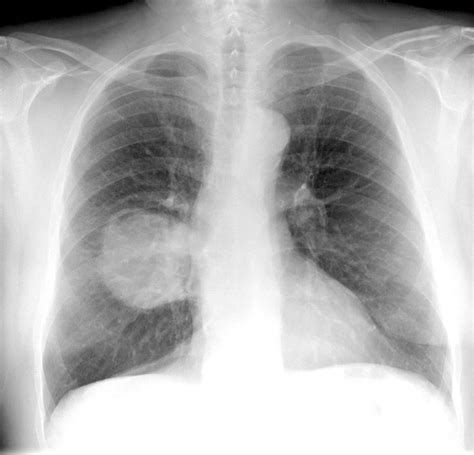 X Ray Images Of Mesothelioma