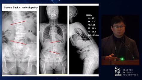 clinical and radiological results of alif with ppsf to treat adult lumbar degenerative scoliosis