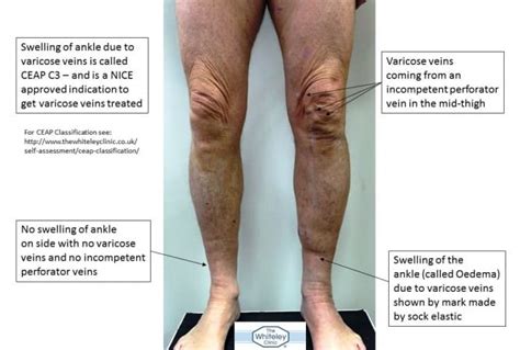 Swollen Ankle From Incompetent Perforator Veins The