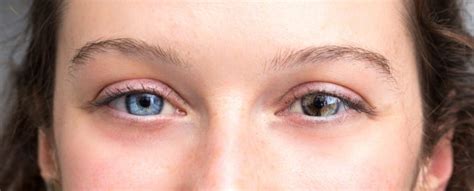 Qué es la heterocromía del iris Ojos de diferente color
