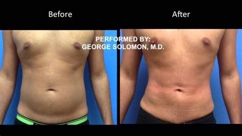 Liposuction Of The Male Abdomen Before And After Gallery Performed By George Solomonmd Youtube