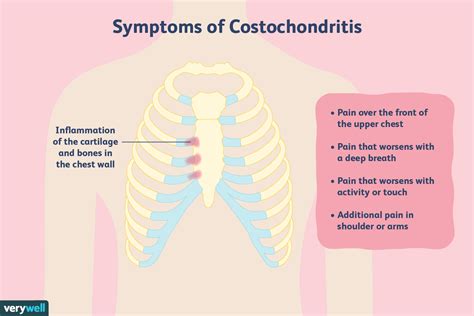 Costochondritis Causes Cures And More