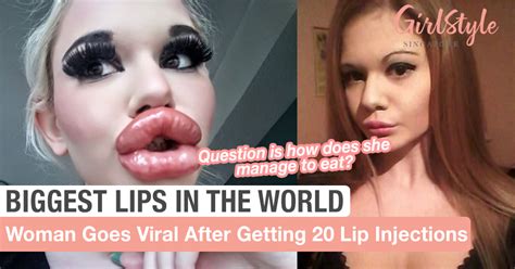 World S Biggest Lips Woman Goes Viral After Getting Lip Injections