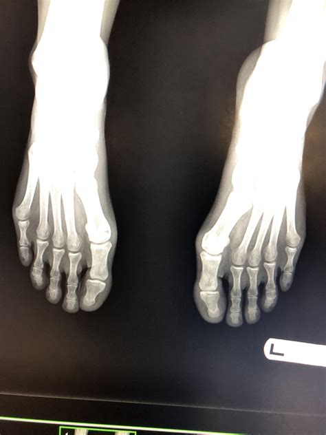 Fractured Left Big Toe Rradiology