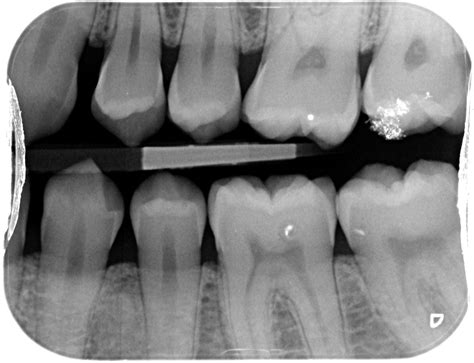 Types Of Dental Radiographs And Their Uses Dentalnotebook