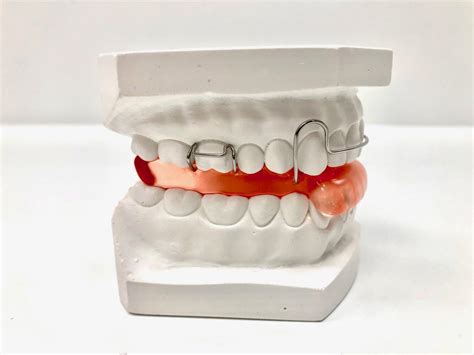 De Blokbeugel Beugelcategorie 3 Orthodontiepraktijk Den Helder