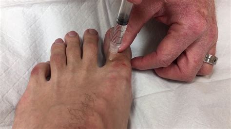 Local Anesthesia In Big Toe For Ingrown Toenail Removal Youtube
