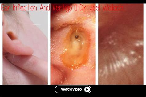 Ear Infection And Vertigo Dr Joel Wallach Vertigo Dizzy Ear