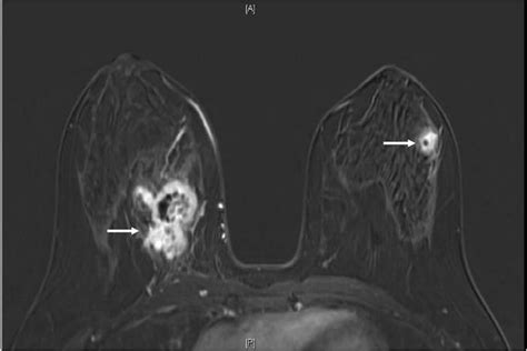 Mri Breast T1 Fat Saturated Post Contrast Subtraction Image Showing