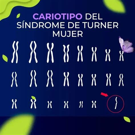 Cariotip o del síndrome de Turner