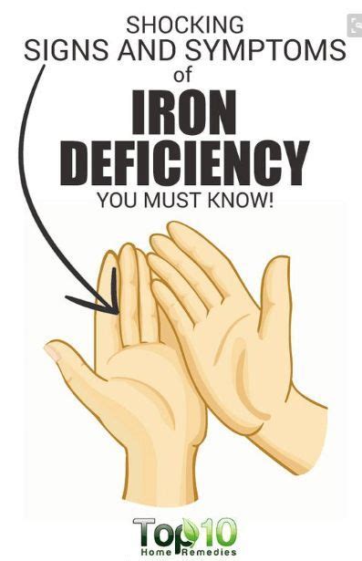 10 Signs And Symptoms Of Iron Deficiency With Images Health Facts