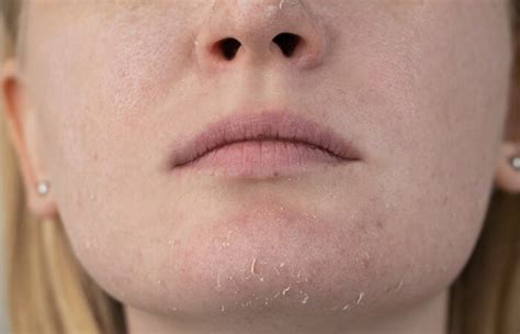 What Medical Conditions Can Cause Dry Skin Around Your Mouth Flash