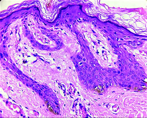 B Histopathology From Hypopigmented Lesions Showing Thin Elongated