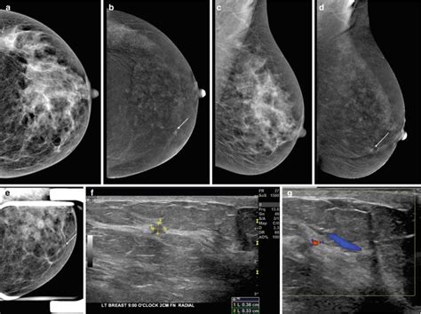 Diagnosis And Staging Of Breast Cancer When And How To Use Mammography