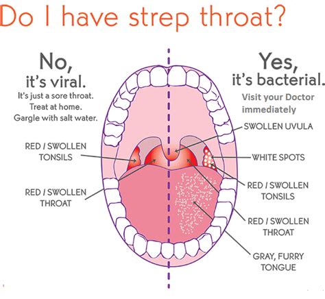 What Does Strep Throat Look Like On Your Tongue What Does