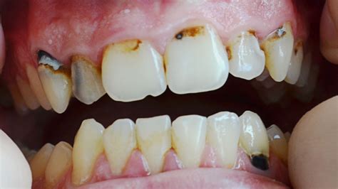 Oral Hygiene Faq What Is Dental Tartar Kirkland Premier Dentistry