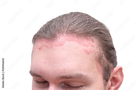 Red Psoraitic Spot On Hairline Dermatological Disease Stress