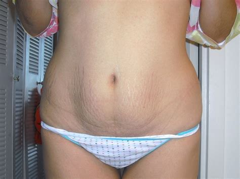 Nude Stretch Marks Telegraph