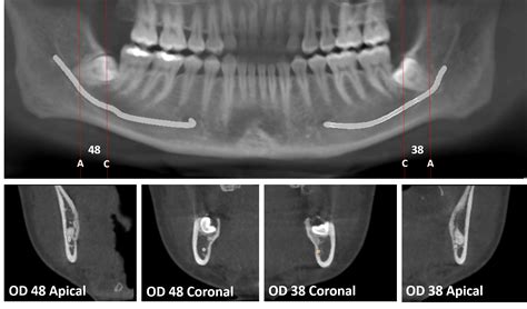 Terceros Molares Mandibulares Impactados Dento Metric Radiología