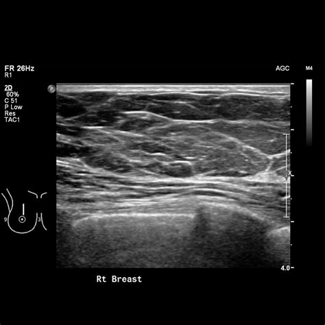 Normal Breast Mammography Tomosynthesis And Ultrasound Image
