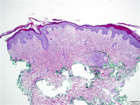 Pathology Outlines Pityriasis Rubra Pilaris