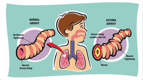 Asthma Allergy