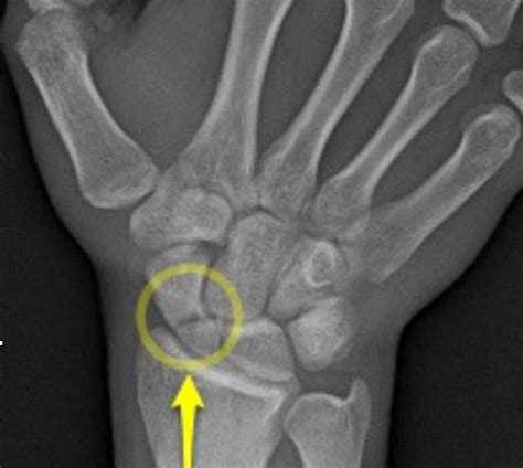 Scaphoid Fracture Causes Symptoms Treatment Scaphoid My XXX Hot Girl