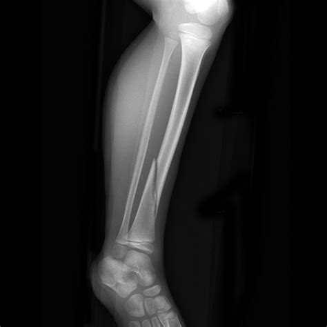 How long will it take for the cuts of a tibia surgery to heal? Leg Xray | Faculty of Medicine