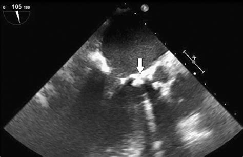 Figure 1 From Calcified Amorphous Tumor Of The Left Ventricular Outflow