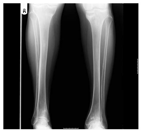 Distal radius fractures programme online course: Bilateral atypical insufficiency fractures of the proximal ...
