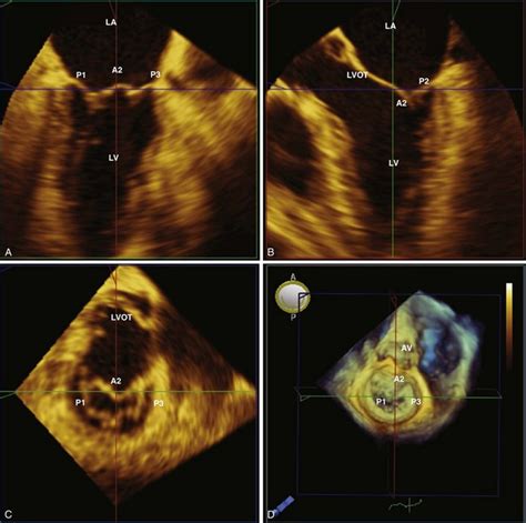 Normal Mitral Valve Anatomy And Measurements Clinical Gate