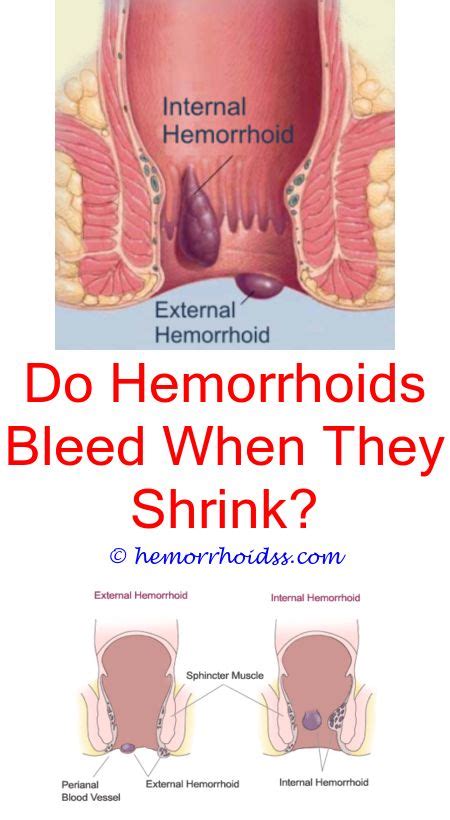 Thrombosed hemorrhoids is a type of hemorrhoid with a clot that partially or fully blocks blood flow. 9 Good Clever Ideas: What Is The Procedure To Remove External Hemorrhoids? how long should ...
