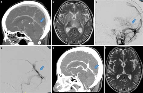 A Ct Venogram Showing Deep Cerebral Venous Sinus Thrombosis Involving