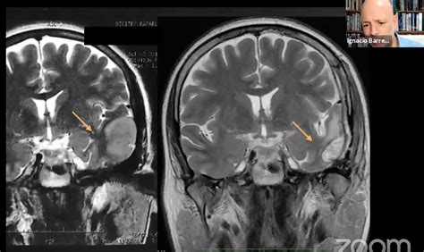 Awake Craniotomy For Gliomas Involving Dominant Temporal Lobe — Dr