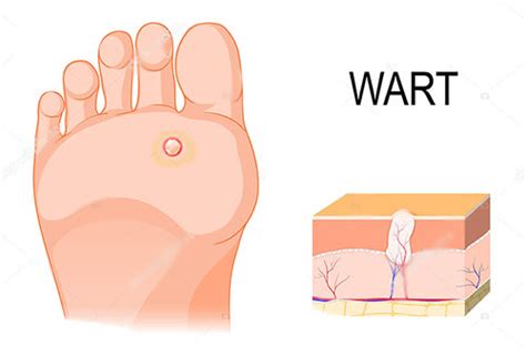 warts a new step foot and ankle clinic podiatrist colorado springs
