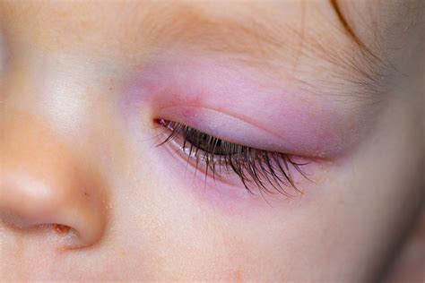 Swollen Eye In Babies Causes Treatment And Home Remedies Baby Care