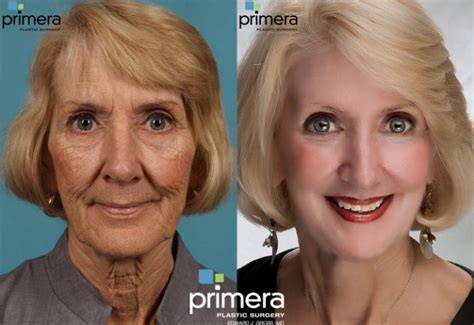 Chemical Peel Before And After Pictures Case 81 Orlando Florida Primera Plastic Surgery