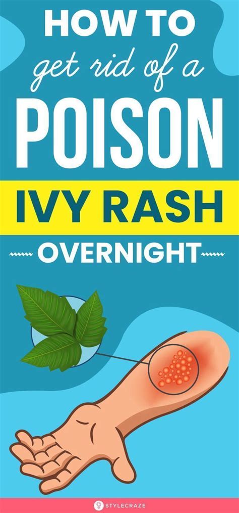 How To Get Rid Of A Poison Ivy Rash Overnight Poison Ivy Rash Poison Ivy Cure Poison Ivy