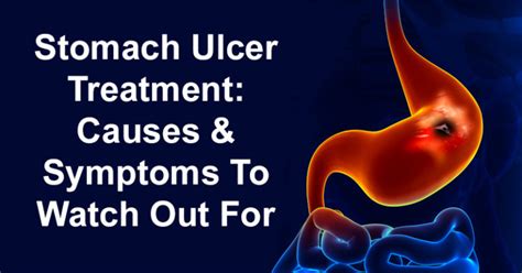 Stomach Ulcers Symptoms And Treatment