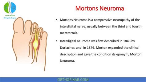 Mortons Neuroma • Easy Explained Orthofixar 2024