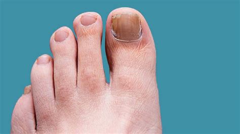 Toenail fungus, or onychomycosis, occurs when fungi infect one or more toenails. How to Stamp Out Toenail and Foot Fungus | Everyday Health