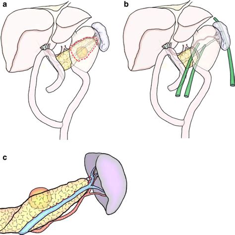 Spleen‐preserving Distal Pancreatectomy With Conservation Of The