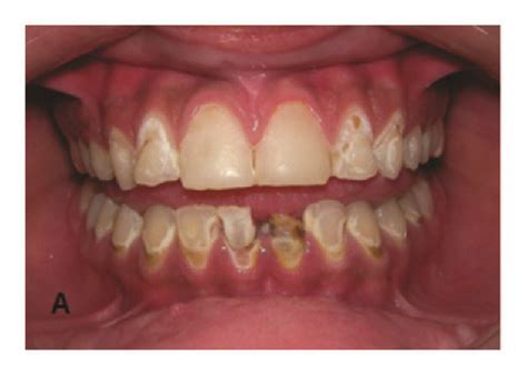 A The Initial Clinical Appearance Demonstrating Carious Lesions On